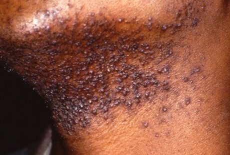 Razor Burn: Causes & Treatment